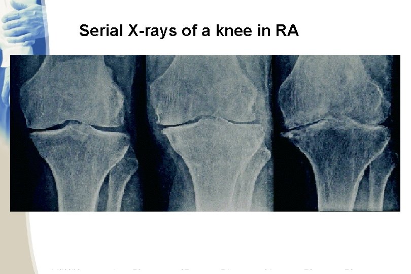 Serial X-rays of a knee in RA 