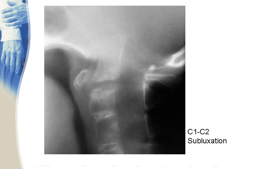 C 1 -C 2 Subluxation 