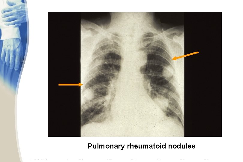 Pulmonary rheumatoid nodules 