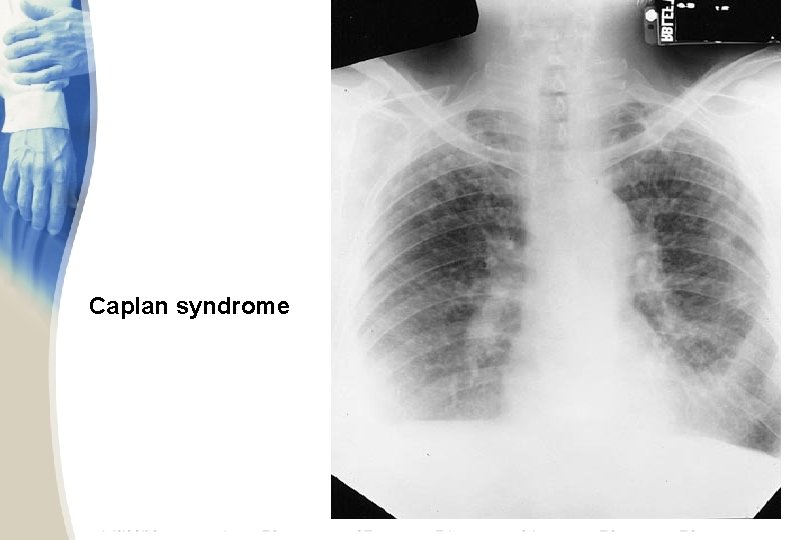 Caplan syndrome 