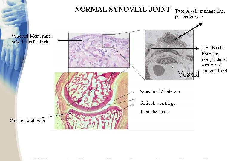 NORMAL SYNOVIAL JOINT Type A cell: mphage like, protective role Synovial Membrane: only 1