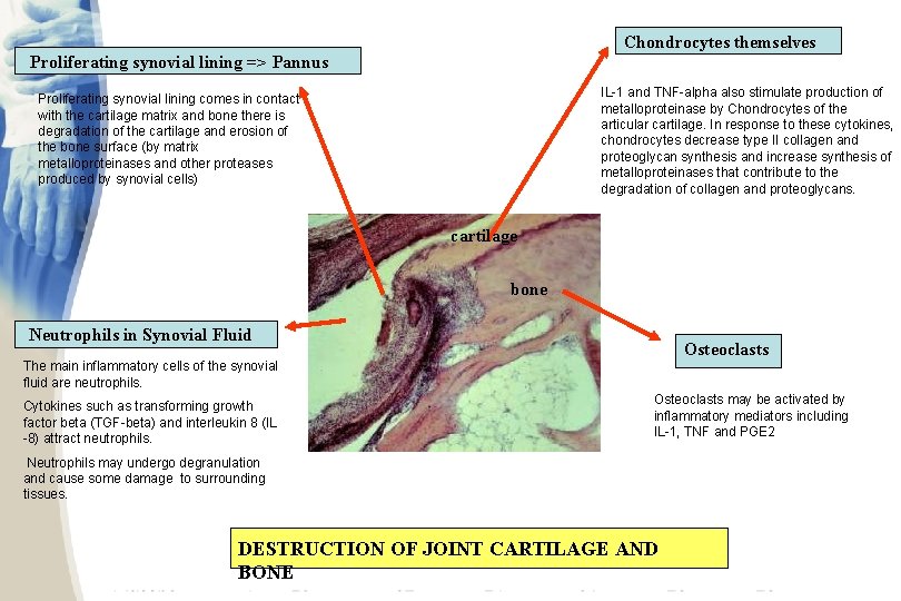 Chondrocytes themselves Proliferating synovial lining => Pannus IL-1 and TNF-alpha also stimulate production of