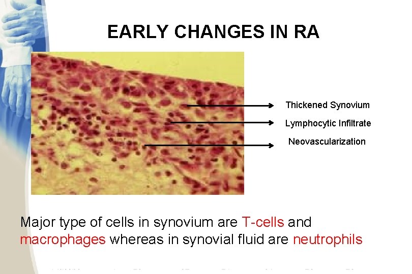 EARLY CHANGES IN RA Thickened Synovium Lymphocytic Infiltrate Neovascularization Major type of cells in