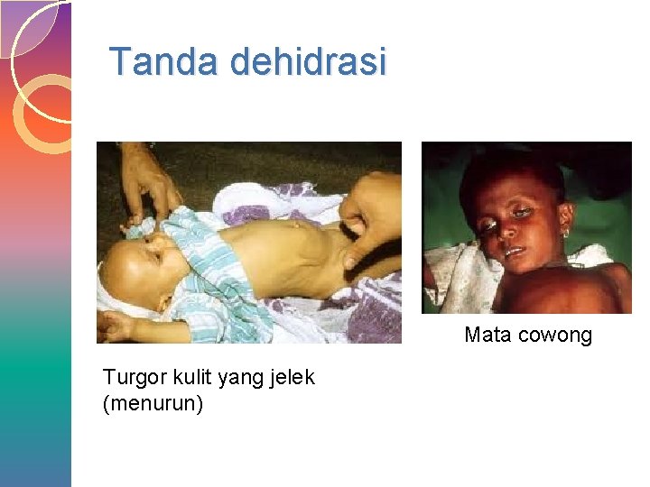 Tanda dehidrasi Mata cowong Turgor kulit yang jelek (menurun) 