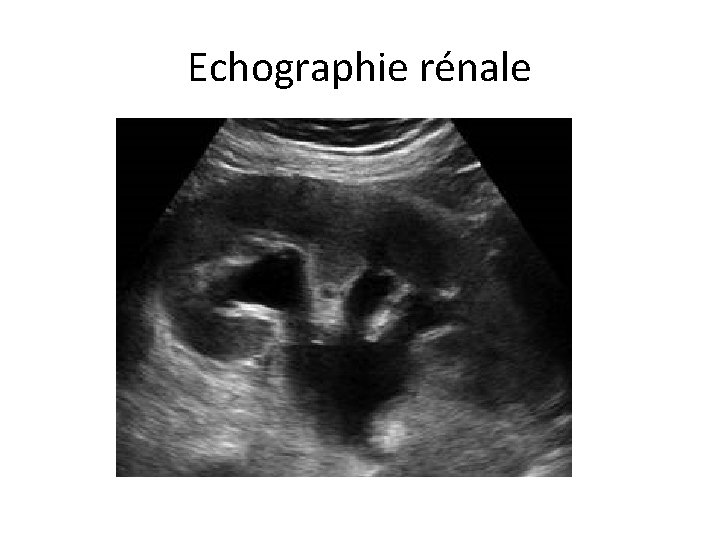 Echographie rénale 