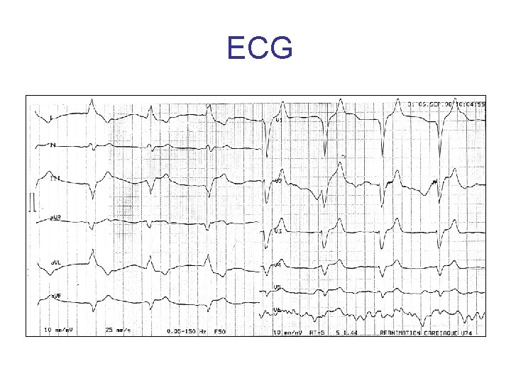 ECG 