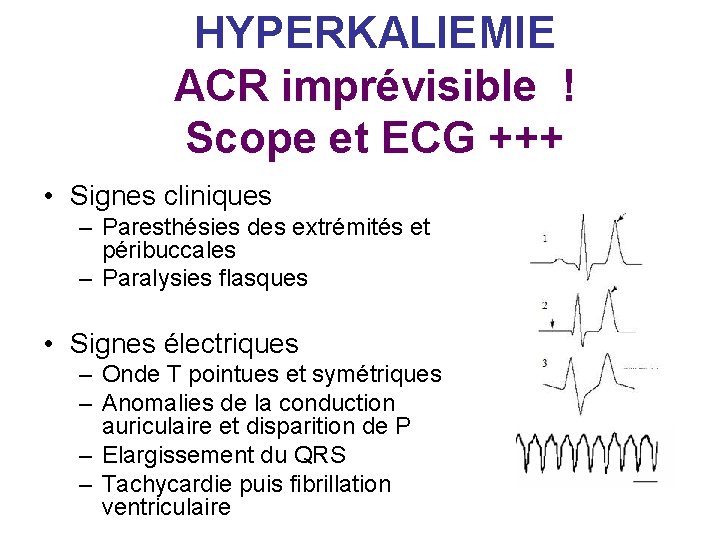 HYPERKALIEMIE ACR imprévisible ! Scope et ECG +++ • Signes cliniques – Paresthésies des