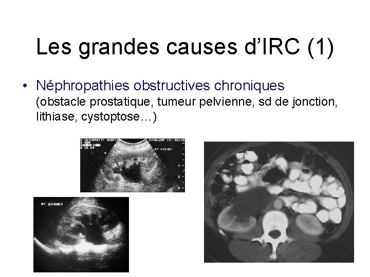Les grandes causes d’IRC (1) • Néphropathies obstructives chroniques (obstacle prostatique, tumeur pelvienne, sd