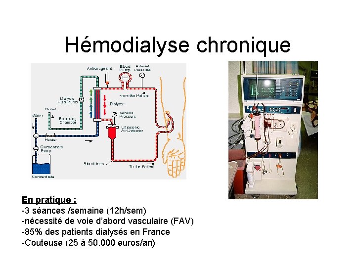 Hémodialyse chronique En pratique : -3 séances /semaine (12 h/sem) -nécessité de voie d’abord