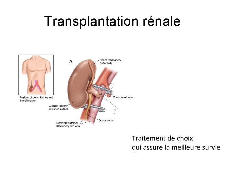 Transplantation rénale Traitement de choix qui assure la meilleure survie 