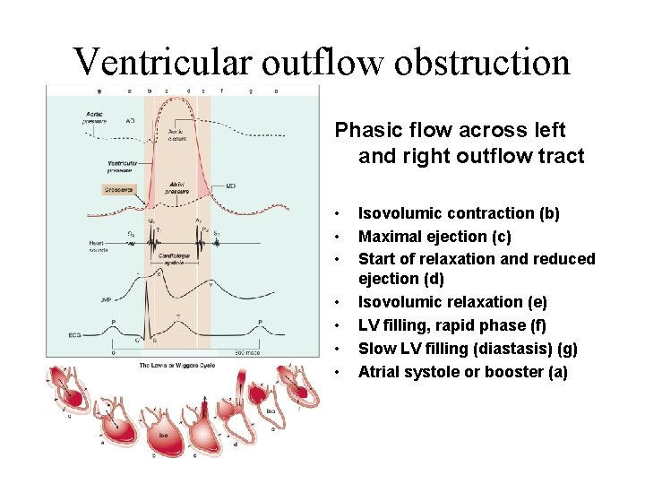 Ventricular outflow obstruction Phasic flow across left and right outflow tract • • Isovolumic