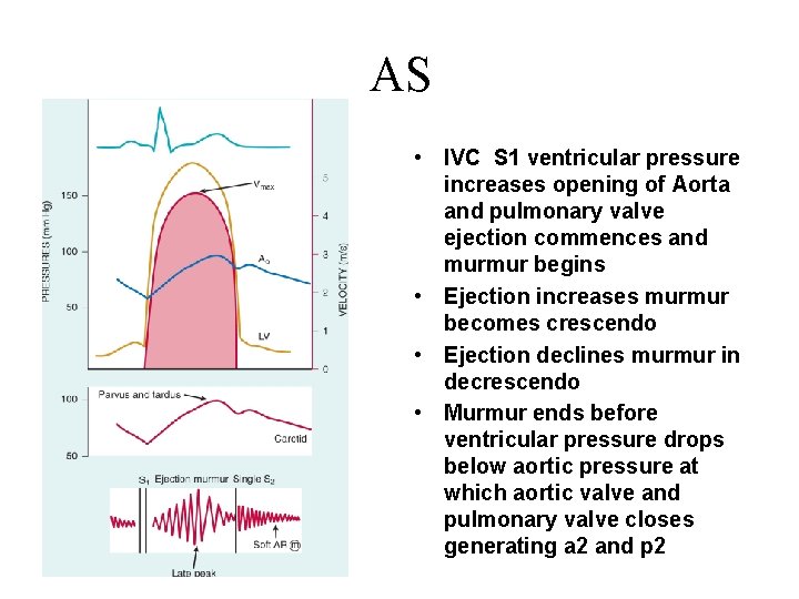 AS • IVC S 1 ventricular pressure increases opening of Aorta and pulmonary valve