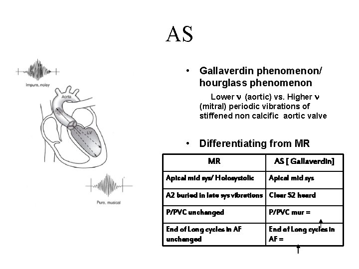 AS • Gallaverdin phenomenon/ hourglass phenomenon Lower n (aortic) vs. Higher n (mitral) periodic