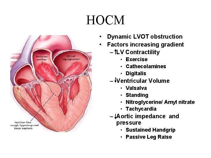 HOCM • Dynamic LVOT obstruction • Factors increasing gradient – LV Contractility • Exercise