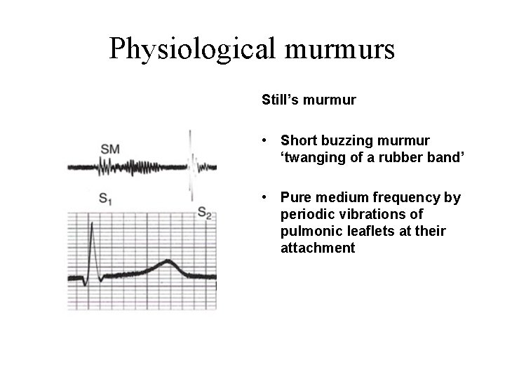 Physiological murmurs Still’s murmur • Short buzzing murmur ‘twanging of a rubber band’ •