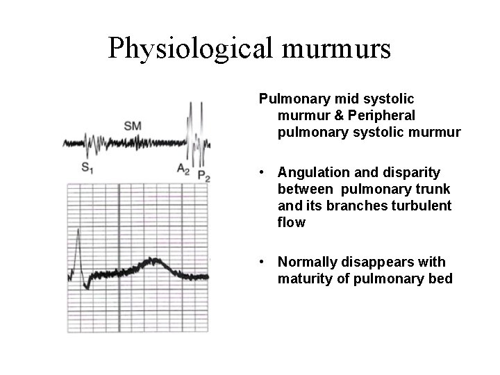 Physiological murmurs Pulmonary mid systolic murmur & Peripheral pulmonary systolic murmur • Angulation and