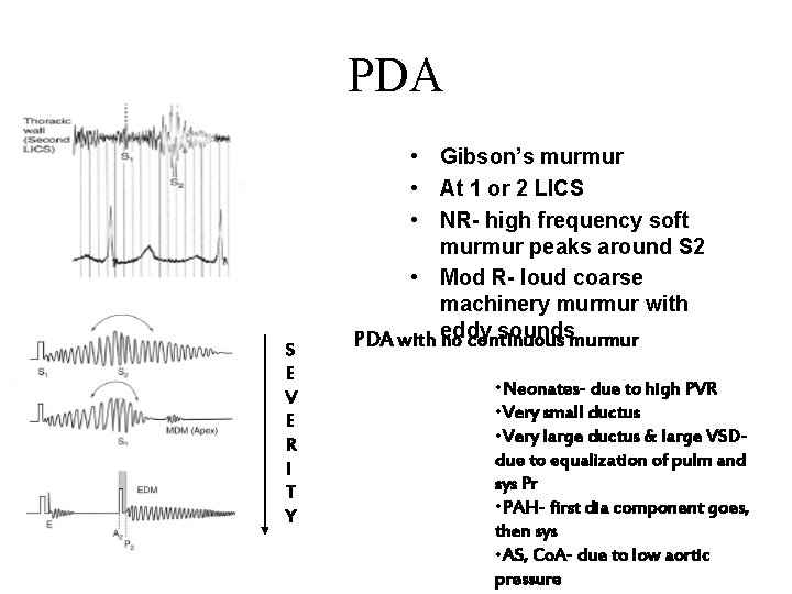 PDA S E V E R I T Y • Gibson’s murmur • At