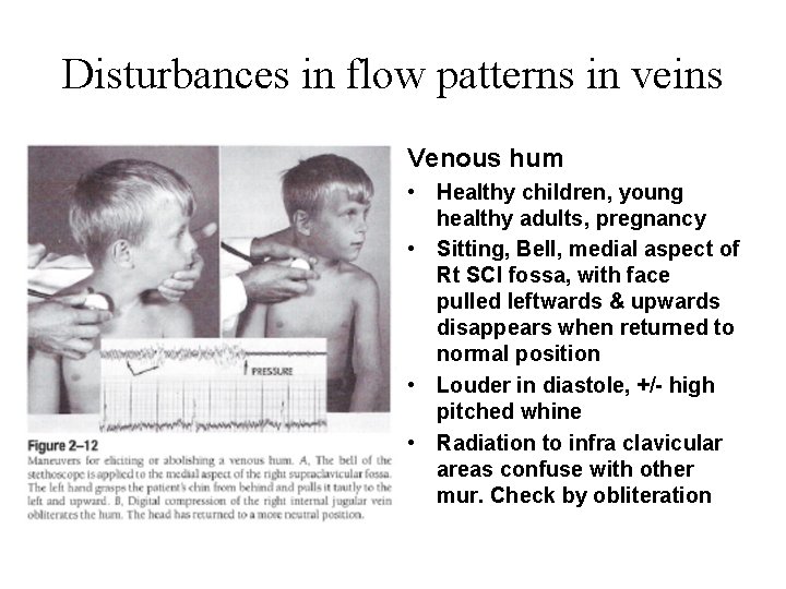 Disturbances in flow patterns in veins Venous hum • Healthy children, young healthy adults,