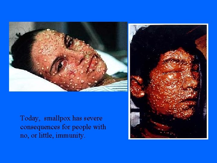 Today, smallpox has severe consequences for people with no, or little, immunity. 