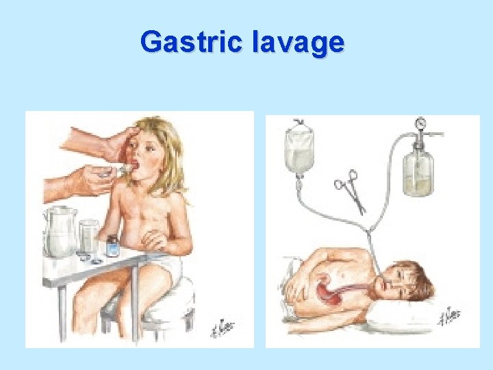 Gastric lavage 