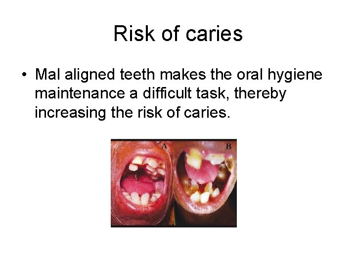 Risk of caries • Mal aligned teeth makes the oral hygiene maintenance a difficult