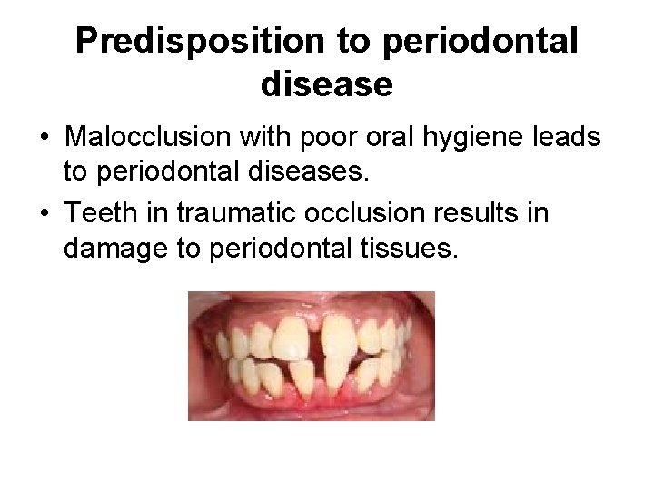 Predisposition to periodontal disease • Malocclusion with poor oral hygiene leads to periodontal diseases.