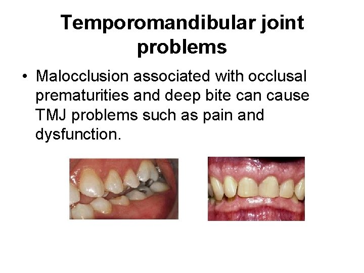 Temporomandibular joint problems • Malocclusion associated with occlusal prematurities and deep bite can cause