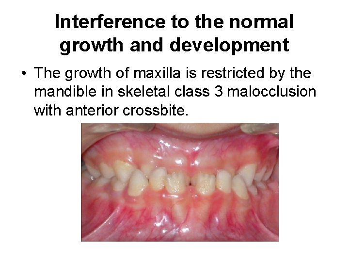 Interference to the normal growth and development • The growth of maxilla is restricted