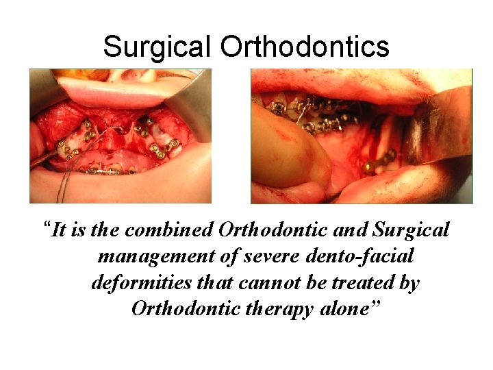 Surgical Orthodontics “It is the combined Orthodontic and Surgical management of severe dento-facial deformities