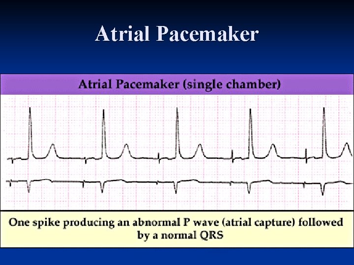 Atrial Pacemaker 