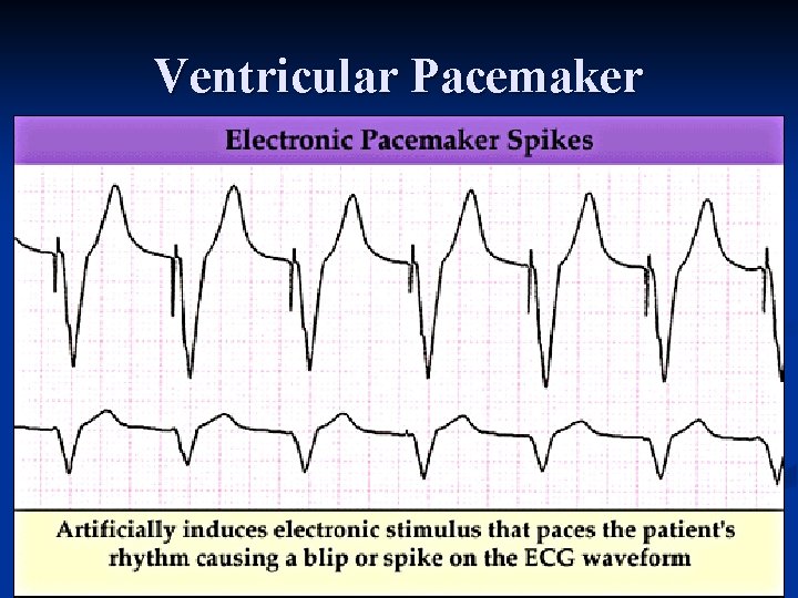 Ventricular Pacemaker 