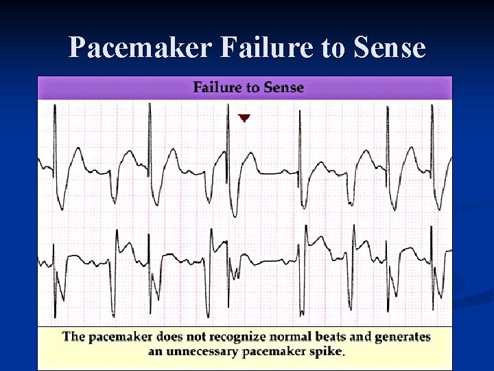 Pacemaker Failure to Sense 