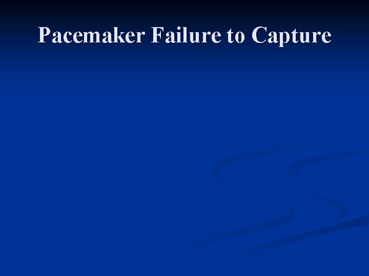 Pacemaker Failure to Capture 