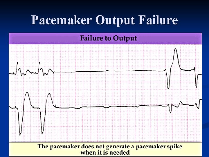 Pacemaker Output Failure 