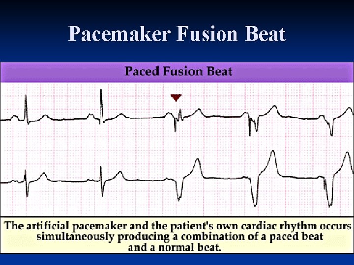 Pacemaker Fusion Beat 