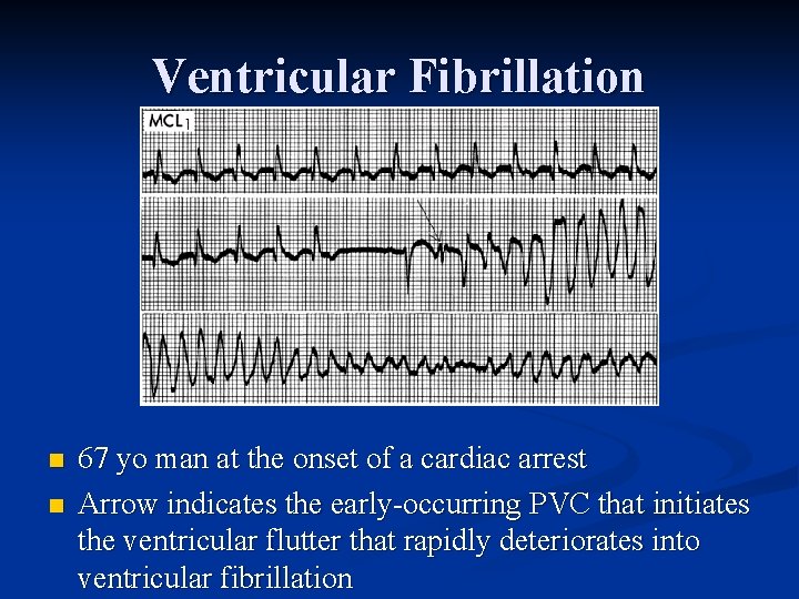 Ventricular Fibrillation n n 67 yo man at the onset of a cardiac arrest