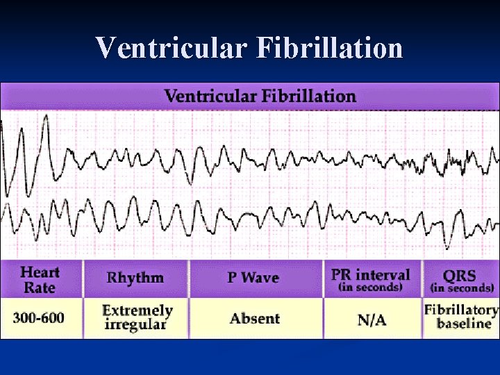 Ventricular Fibrillation 