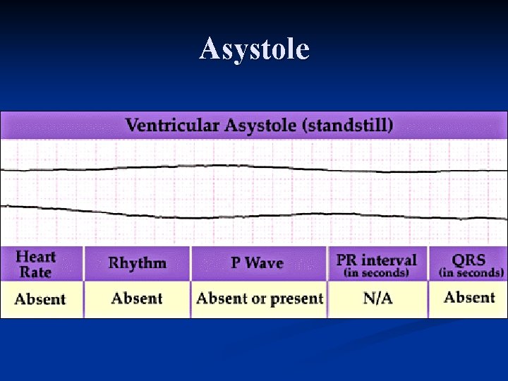 Asystole 