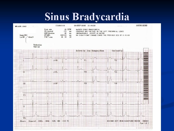 Sinus Bradycardia 