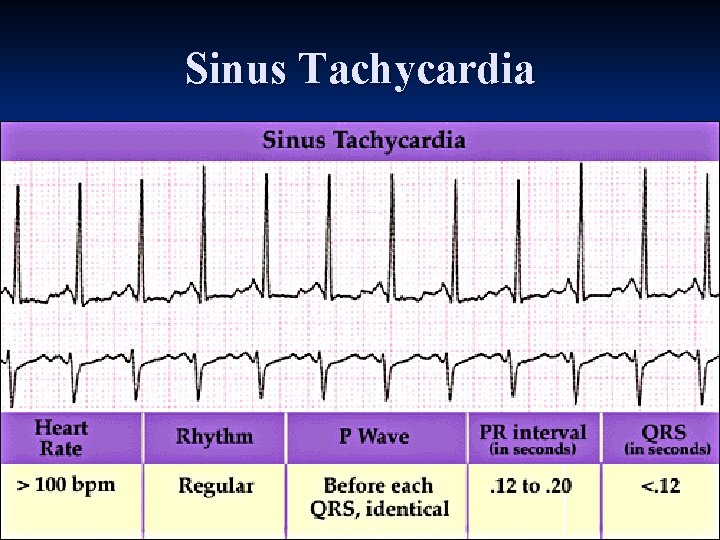 Sinus Tachycardia 