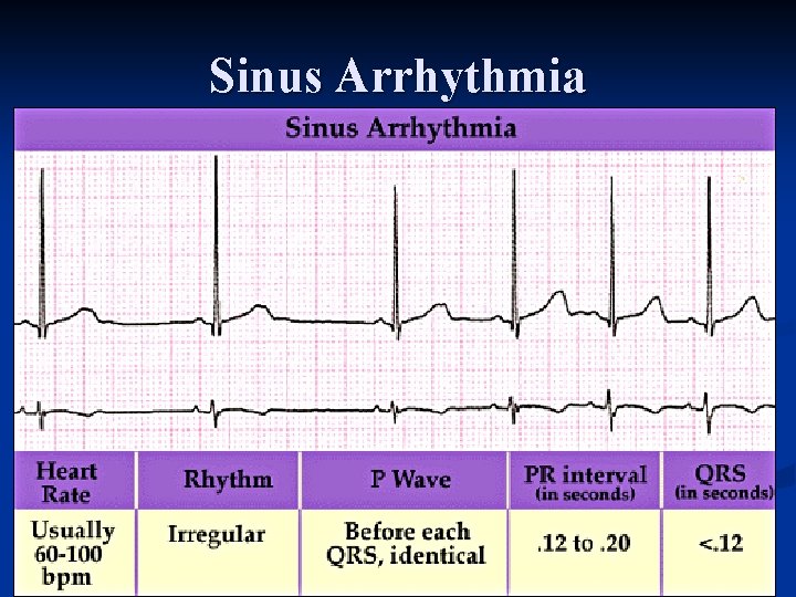 Sinus Arrhythmia 