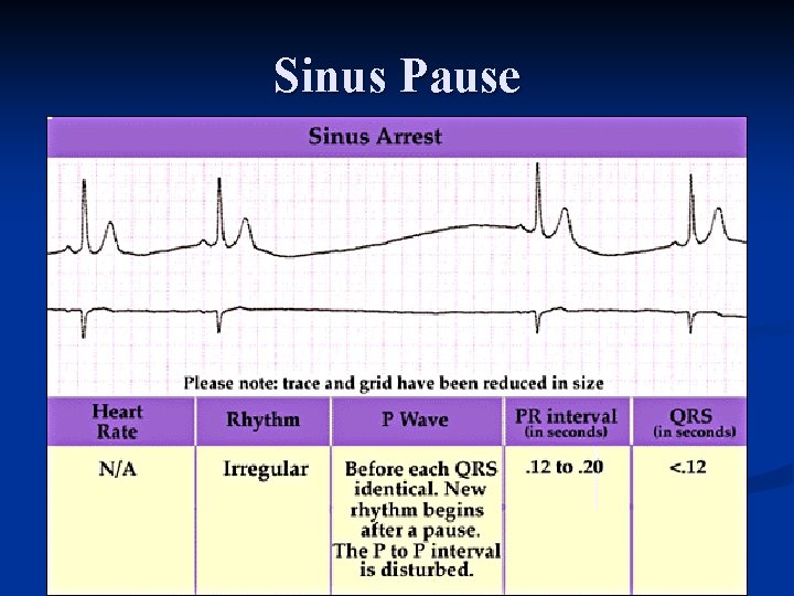 Sinus Pause 