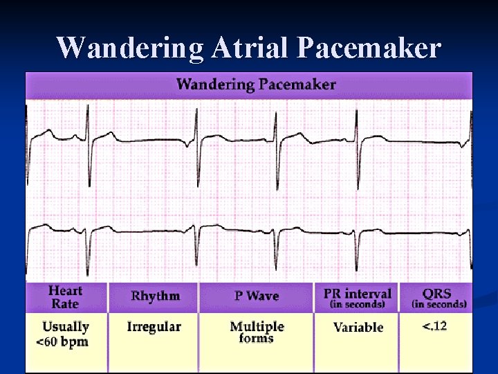 Wandering Atrial Pacemaker 