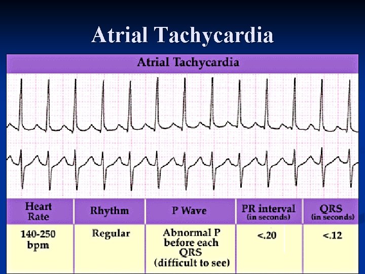 Atrial Tachycardia 