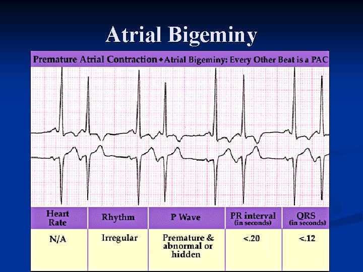 Atrial Bigeminy 