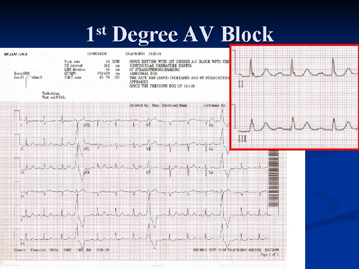 1 st Degree AV Block 