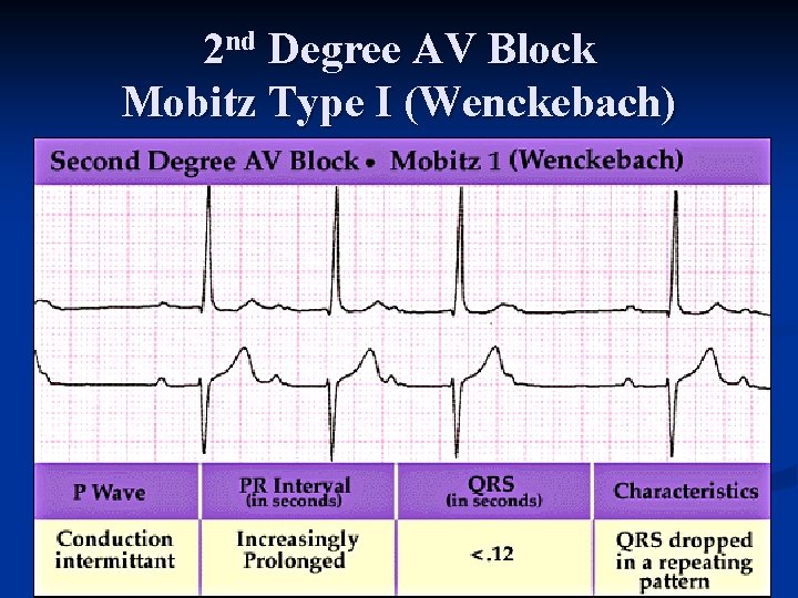 2 nd Degree AV Block Mobitz Type I (Wenckebach) 