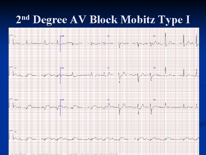 2 nd Degree AV Block Mobitz Type I 