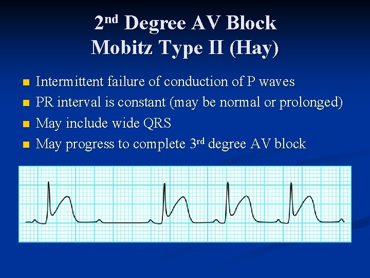 2 nd Degree AV Block Mobitz Type II (Hay) n n Intermittent failure of