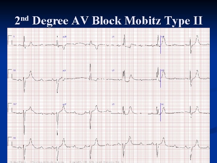 2 nd Degree AV Block Mobitz Type II 